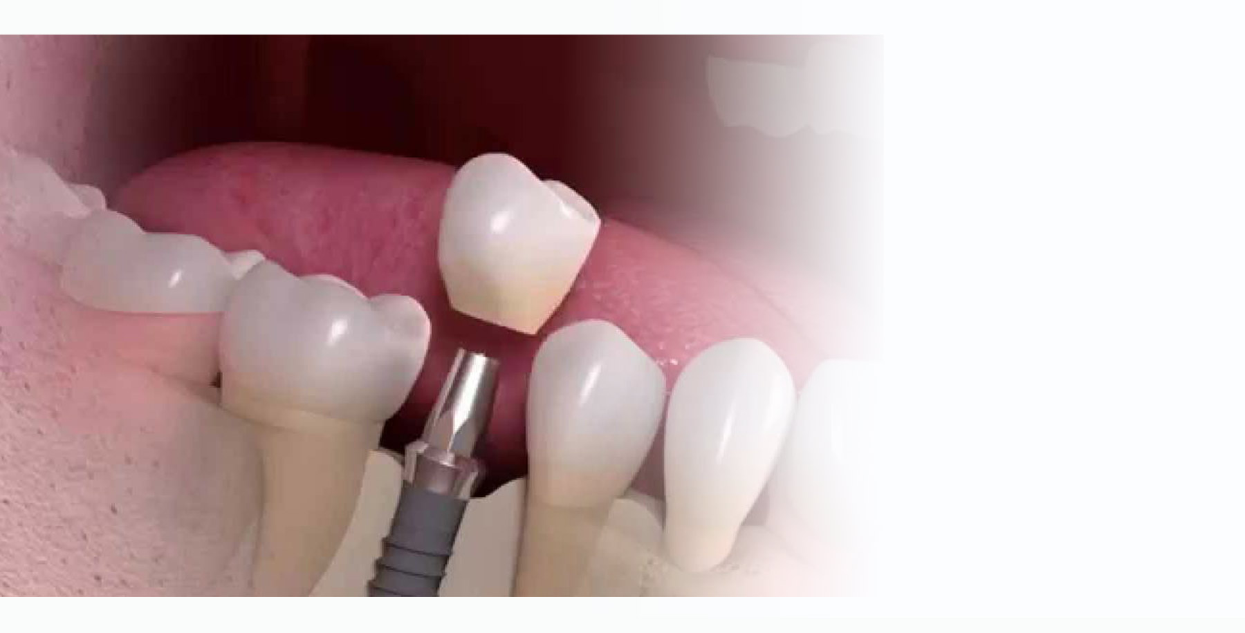 Dental Implants with Abutments and Crowns