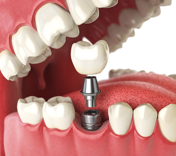 Los Angeles Will I Need a Bone Graft for Dental Implants