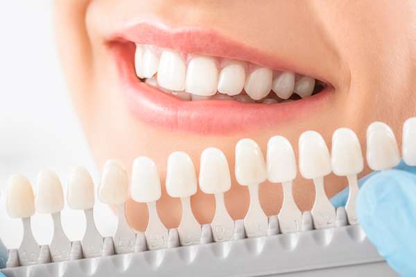 Caring for Veneers After a Cosmetic Dentist Treatment from Allure Dentistry in Los Angeles, CA