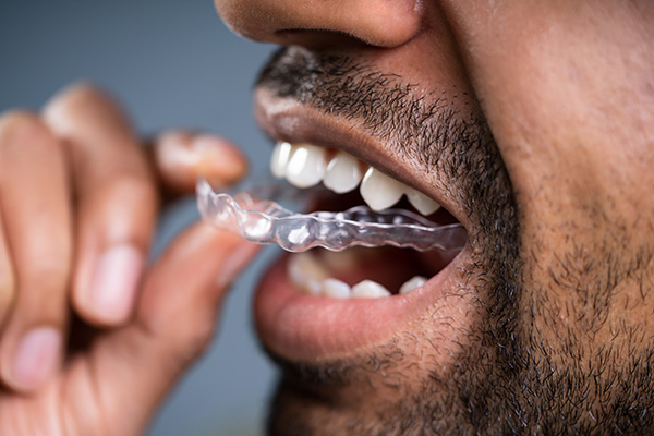 A Cosmetic Dentist Explains Benefits of Clear Aligners from Allure Dentistry in Los Angeles, CA