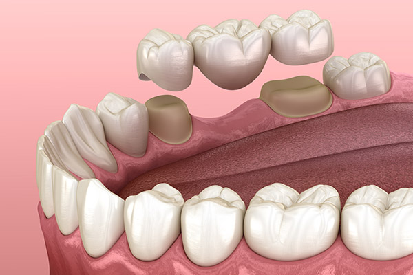 Dental Bridge Options for Replacing Missing Teeth