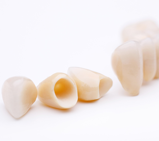 Los Angeles Dental Crowns and Dental Bridges