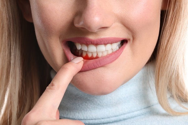 What Are The Stages Of Gum Disease?