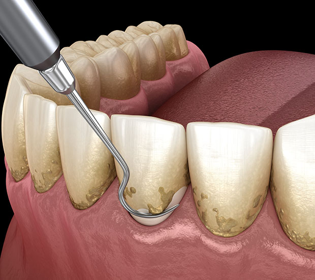 Los Angeles Root Scaling and Planing